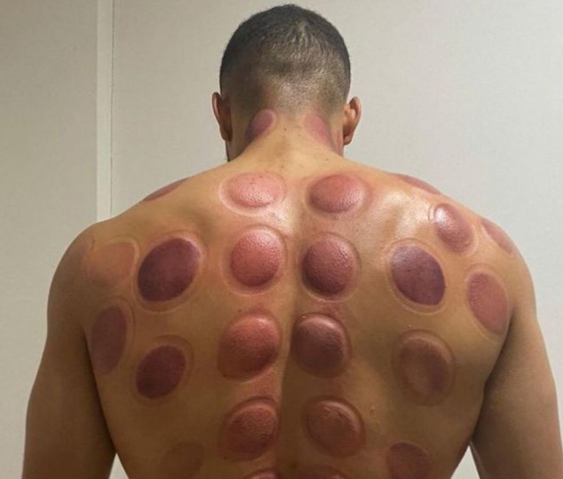 本泽马推荐的？黄潜前锋丹朱马晒拔罐治疗照