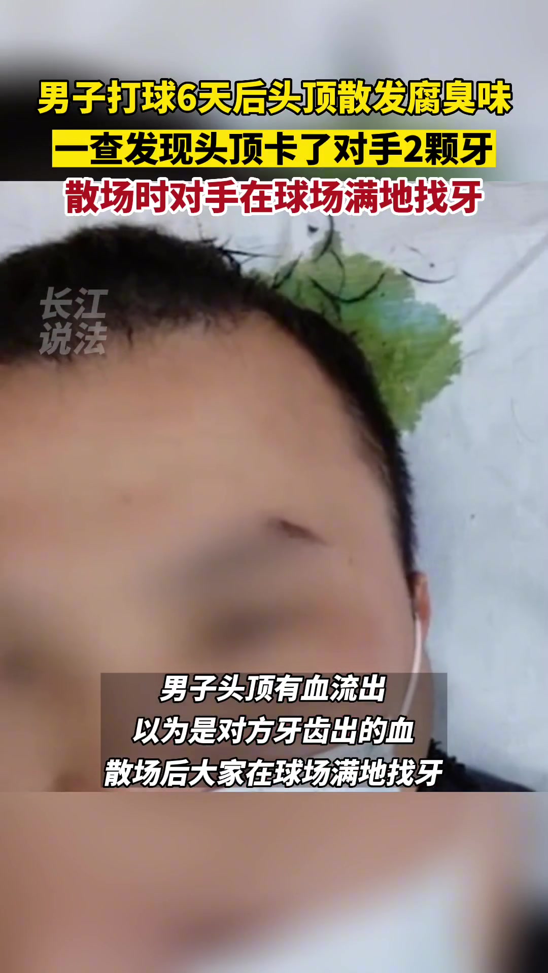男子打球6天后头顶散发腐臭味 一查发现头顶卡了对手2颗牙