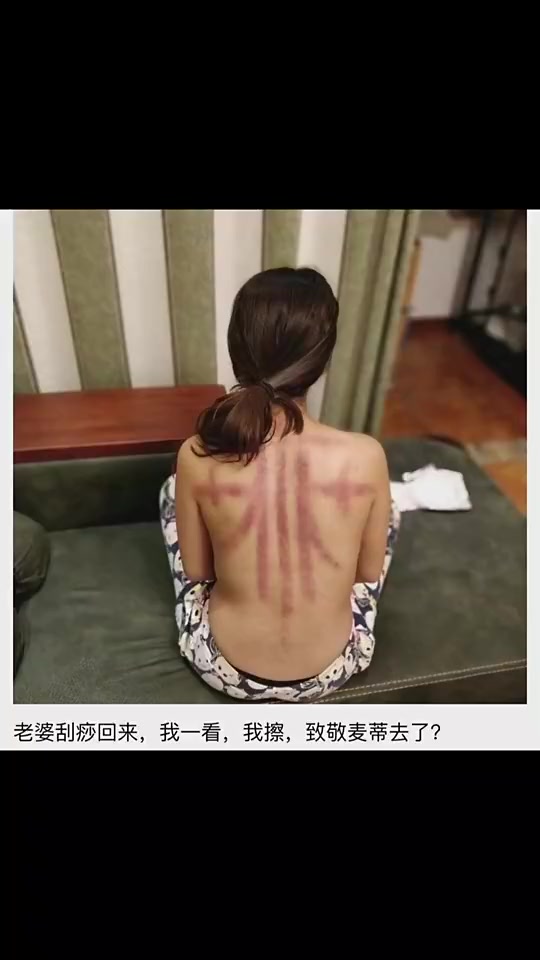 好家伙，老婆这刮痧是去致敬麦迪吗？