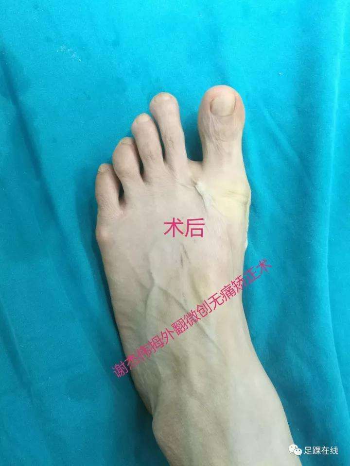 大脚骨图片「大脚骨的症状图片」