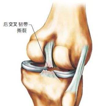 髌腱「髌腱损伤多久可以恢复」